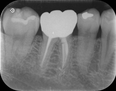 補綴（白い歯を被せた治療）後1年経過のデンタルレントゲン像