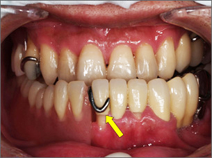 正面から見た治療後の口中の写真 Before（保険の入れ歯装着）