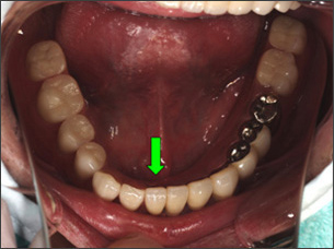 下顎からみた治療後の口中の写真 After（審美的な入れ歯装着）