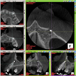 歯科用CTによる検査