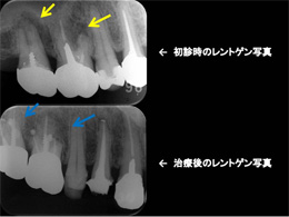 治療前後のレントゲン写真の比較