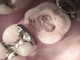 左上第一大臼歯部（左上6部）銀歯（インレー）除去