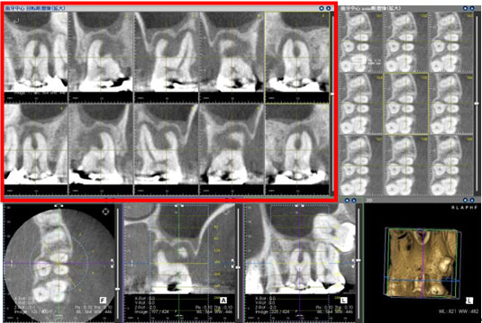 歯科用CTスキャンによる診断