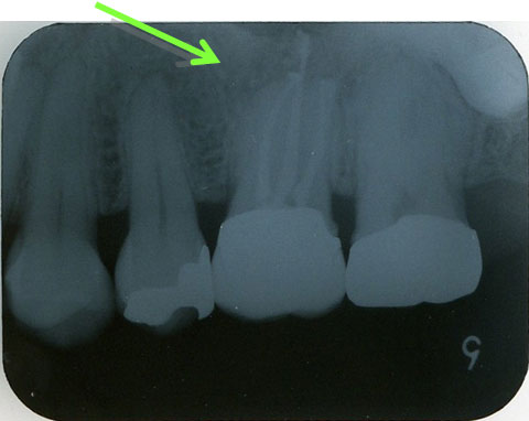 左上第一大臼歯部 デンタルレントゲン（治療後2年経過）