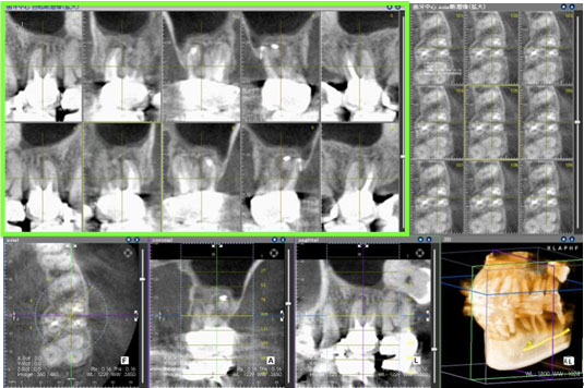 歯科用CTスキャンにて治療経過の確認