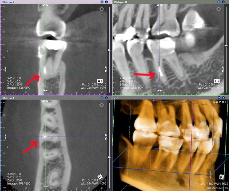 歯科用CTによる画像診断