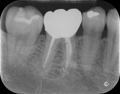 補綴（白い歯を被せた治療）後のデンタルレントゲン像