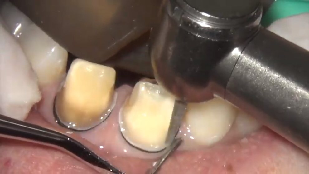 歯を削っている様子の実際（簡易動画）
