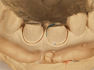 実際の歯形から出来た模型
