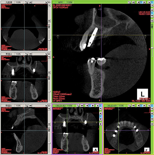 歯科用CTによる精密検査