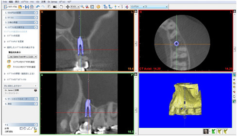 シムプラントでの術前CT画像診断