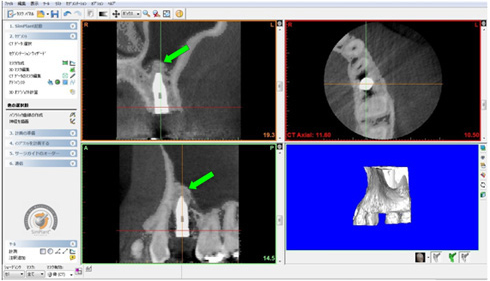 シムプラントでの術後CT画像診断