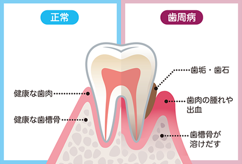 歯周病治療（歯周形成外科・歯周組織再生療法）